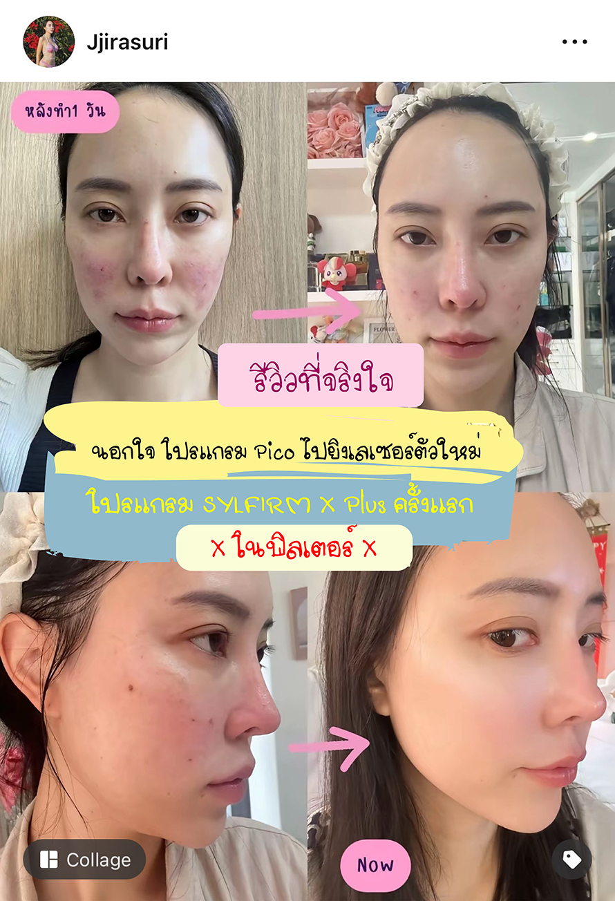 นอกใจโปรแกรมเลเซอร์ Pico ลองของใหม่ โปรแกรม SylfirmXplus ขอบคุณรีวิวดูแลหลุมสิวด้วยโปรแกรม SylfirmX Plus จากคุณจูนครับ