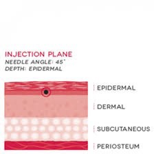 Update Skin Booster ตัวใหม่ Neauvia Hydro Deluxe: Calcium Hydroxyapatite CaHA สร้างคอลลาเจนหลุมสิว Collagen Biostimulator + Non Cross-linked Hyaluronic Acid (HA) ให้ความชุ่มชื้นผิว Skin Booster ครับ Update Skin Booster ตัวใหม่ Neauvia Hydro Deluxe: Calcium Hydroxyapatite CaHA สร้างคอลลาเจนหลุมสิว Collagen Biostimulator + Non Cross-linked Hyaluronic Acid (HA) ให้ความชุ่มชื้นผิว Skin Booster ครับ