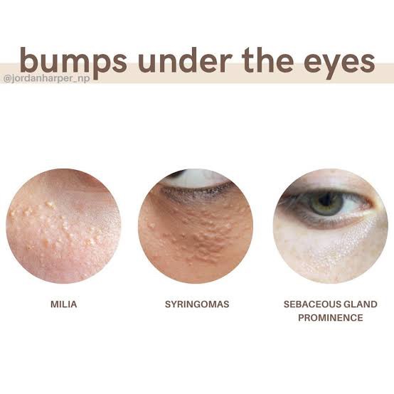 มีตุ่มเล็กๆสีขาวเหลืองหลายๆตุ่มที่เปลือกตาล่างคืออะไร : เป็นต่อมไขมันที่เด่นชัดครับ Prominent sebaceous gland ครับ มีตุ่มเล็กๆสีขาวเหลืองหลายๆตุ่มที่เปลือกตาล่างคืออะไร : เป็นต่อมไขมันที่เด่นชัดครับ Prominent sebaceous gland ครับ