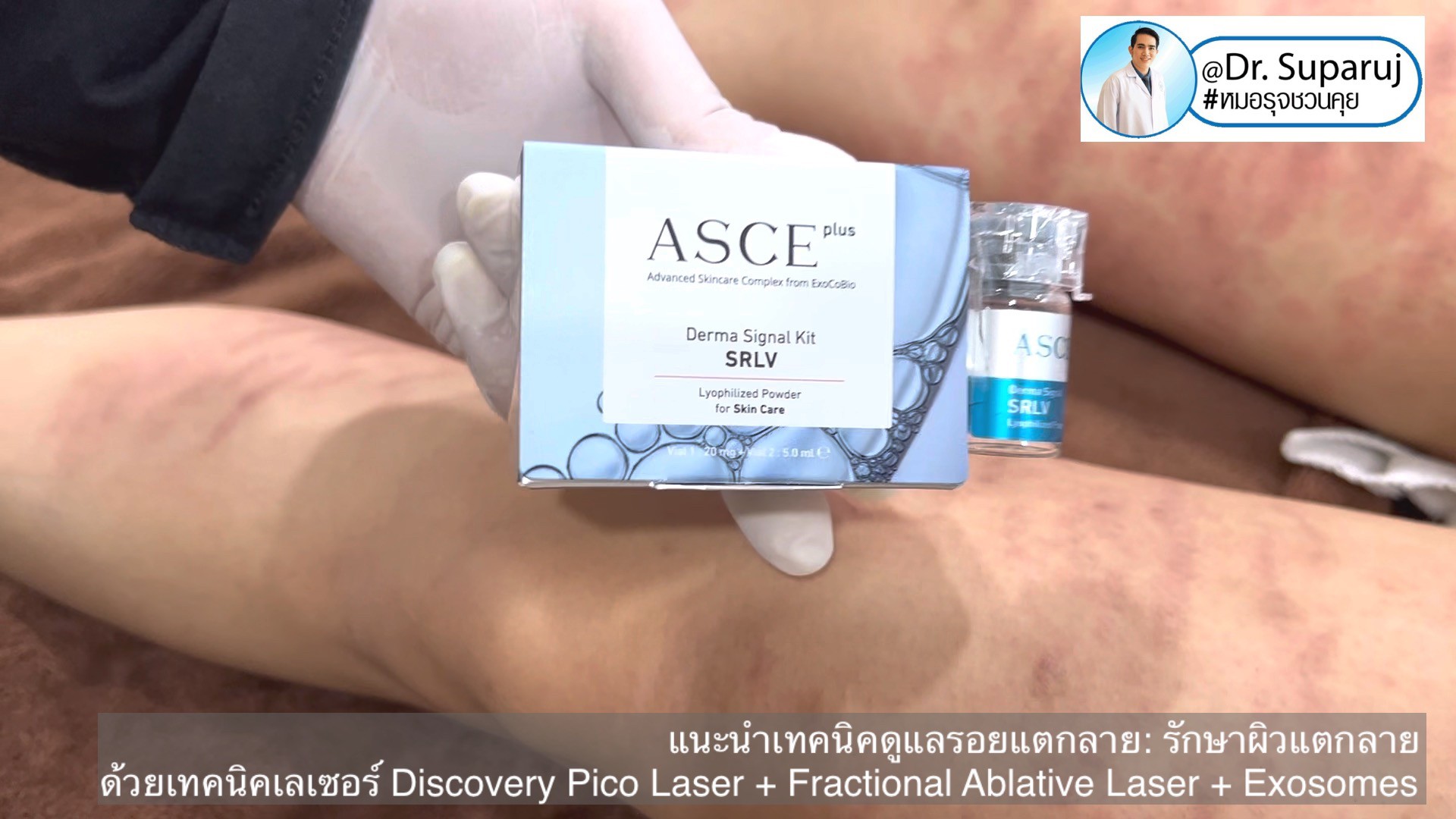 แนะนำเทคนิคดูแลรอยแตกลาย: รักษาผิวแตกลายด้วยเทคนิคเลเซอร์ Discovery Pico Laser + Fractional Ablative Laser + Exosomes แนะนำเทคนิคดูแลรอยแตกลาย: รักษาผิวแตกลายด้วยเทคนิคเลเซอร์ Discovery Pico Laser + Fractional Ablative Laser + Exosomes