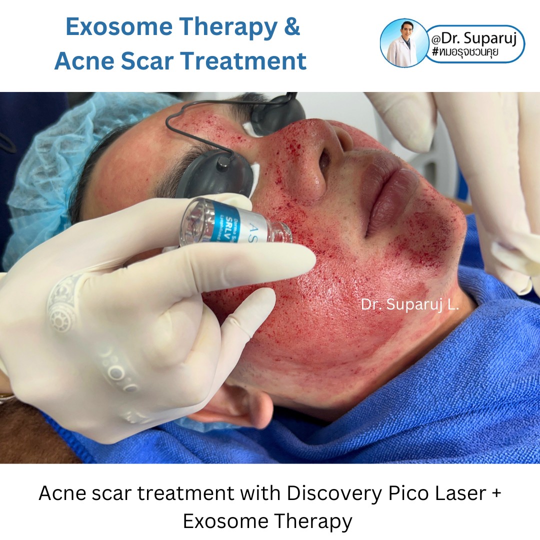 เป็นหลุมสิว แต่ยังไม่พร้อมรักษาหลุมสิว ทำอย่างไรดี? (+ เทคนิคการ เลือกใช้วิธีรักษาลุมสิวเบื้องต้นครับ) เป็นหลุมสิว แต่ยังไม่พร้อมรักษาหลุมสิว ทำอย่างไรดี? (+ เทคนิคการ เลือกใช้วิธีรักษาลุมสิวเบื้องต้นครับ)