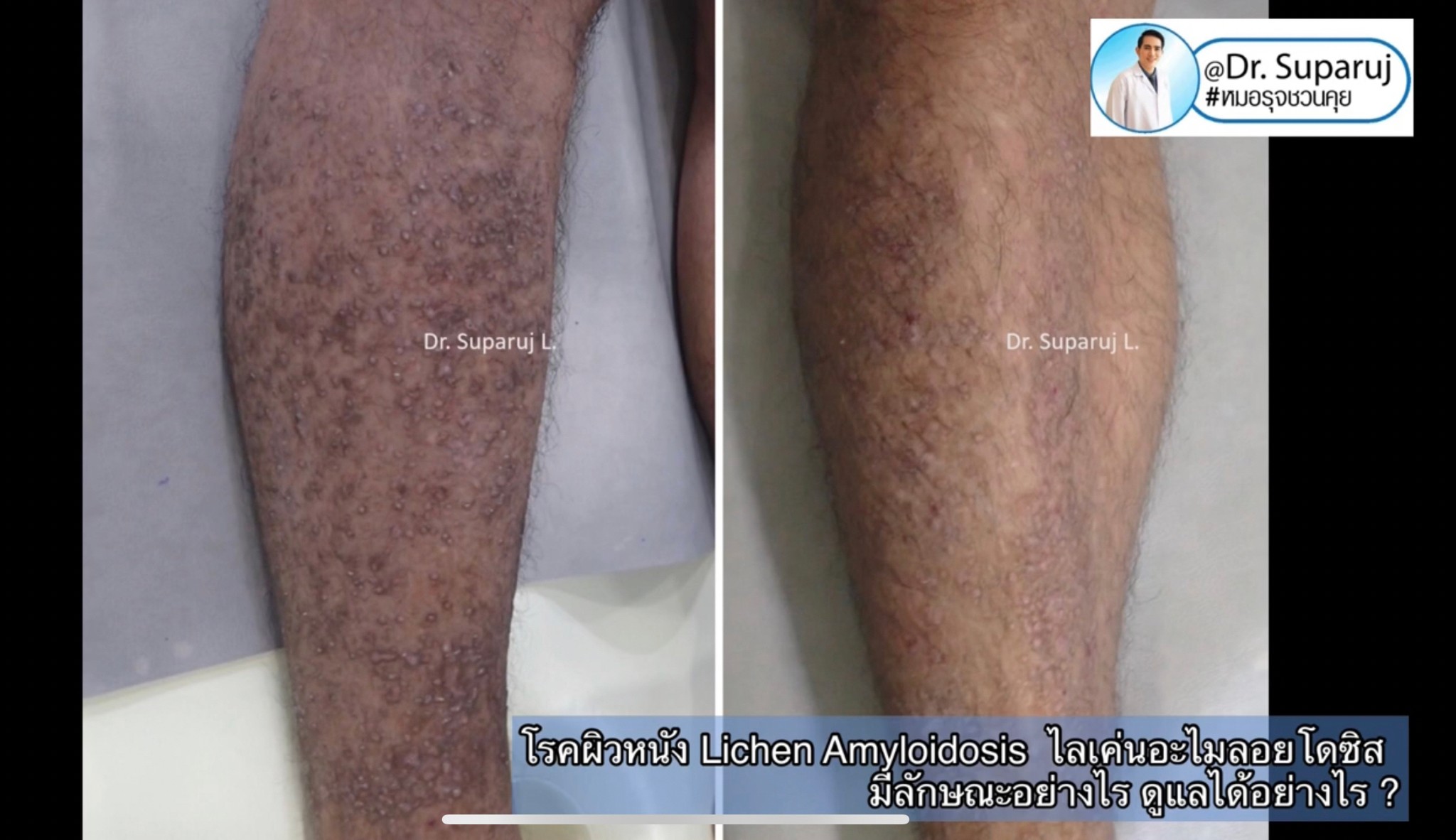 แนะนำการดูแลปัญหาโรคผิวหนัง: โรค Lichen amyloidosis ไลเค่น อะไมลอยโดซิส มีลักษณะอย่างไร ดูแลได้อย่างไร ? แนะนำการดูแลปัญหาโรคผิวหนัง: โรค Lichen amyloidosis ไลเค่น อะไมลอยโดซิส มีลักษณะอย่างไร ดูแลได้อย่างไร ?