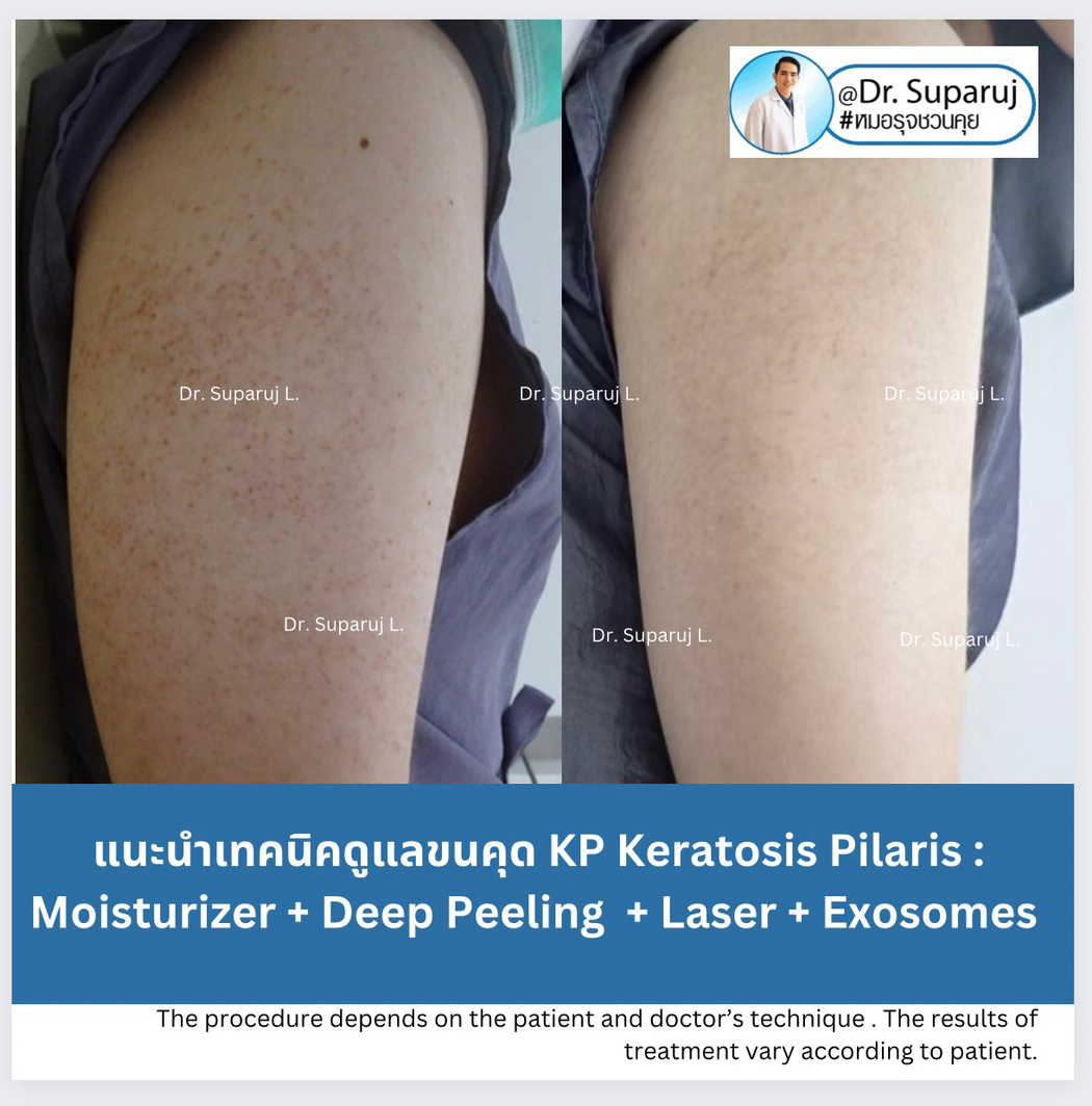 Update ขนคุด Keartosis Pilaris KP เกิดจากอะไร + มีลักษณะอย่างไร + ดูแลได้อย่างไร? Update ขนคุด Keartosis Pilaris KP เกิดจากอะไร + มีลักษณะอย่างไร + ดูแลได้อย่างไร?