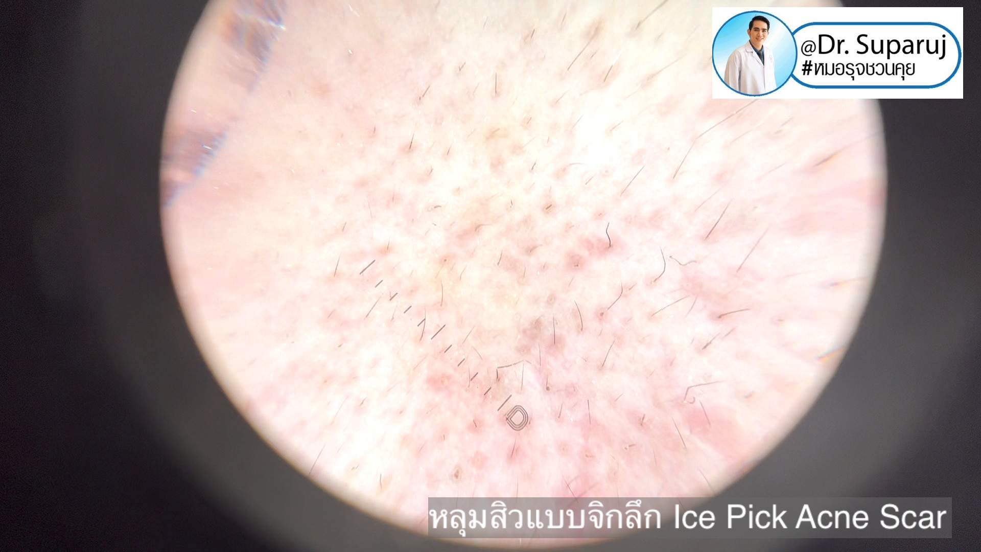Back to the Basics: หลุมสิวมีกี่ชนิด & มีลักษณะอย่างไร ? Acne Scar Classification Full Clip คลิปเต็ม Facebook/ YouTube Dr. Suparuj หมอรุจชวนคุย ครับ Back to the Basics: หลุมสิวมีกี่ชนิด & มีลักษณะอย่างไร ? Acne Scar Classification Full Clip คลิปเต็ม Facebook/ YouTube Dr. Suparuj หมอรุจชวนคุย ครับ