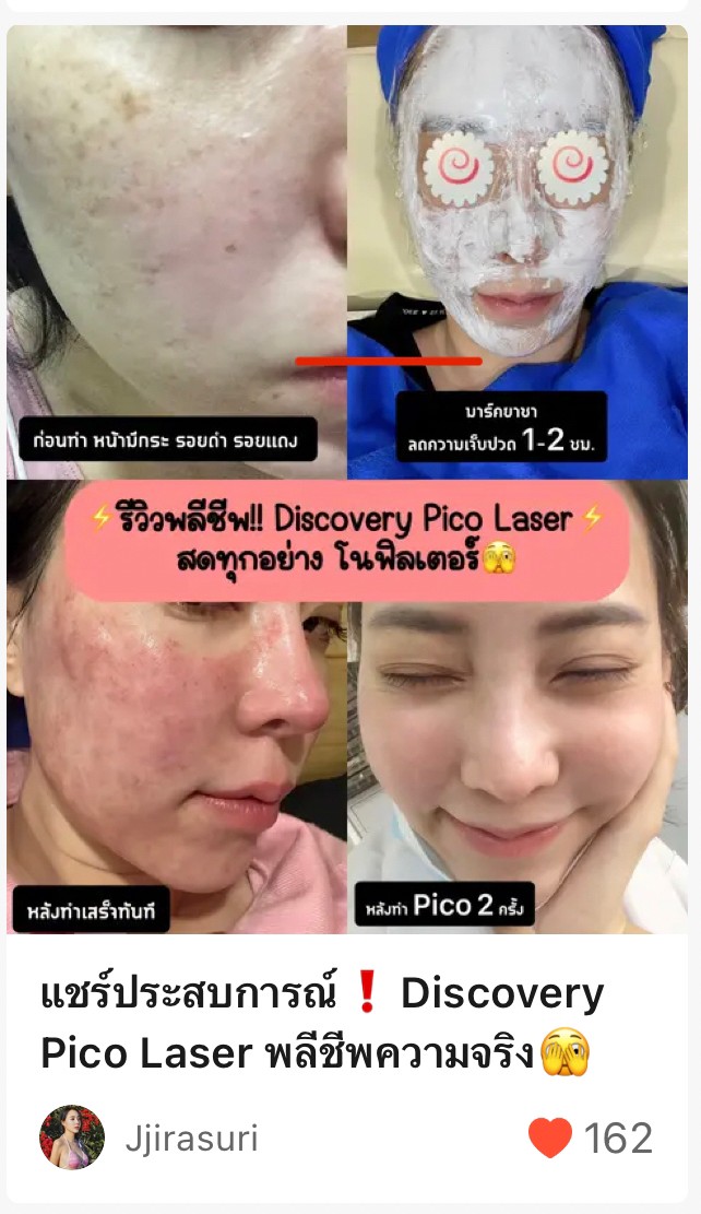 แนะนำเทคนิคดูแลรูขุมขนกว้าง: เทคนิคดูแลรูขุมขนกว้างด้วย Deep Carbon Peel Picosecond Laser (เทคนิคการใช้ Picosecond Laser พิโค่เลเซอร์ ร่วมกับผง carbon กระตุ้นการสร้างคอลลาเจนดูแลรูขุมขนกว้าง )