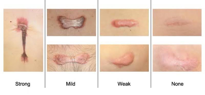 Recap เทคนิครักษาแผลเป็น แผลเป็นนูน คีลอยด์ แผลผ่าตัด Scar Treatment Recap เทคนิครักษาแผลเป็น แผลเป็นนูน คีลอยด์ แผลผ่าตัด Scar Treatment