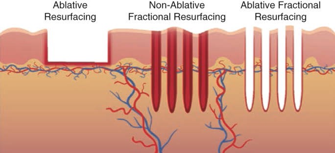 โปรแกรมเลเซอร์ Fractional CO2 Laser ยังใช้รักษาหลุมสิวได้อยู่ไหม ? โปรแกรมเลเซอร์ Fractional CO2 Laser ยังใช้รักษาหลุมสิวได้อยู่ไหม ?