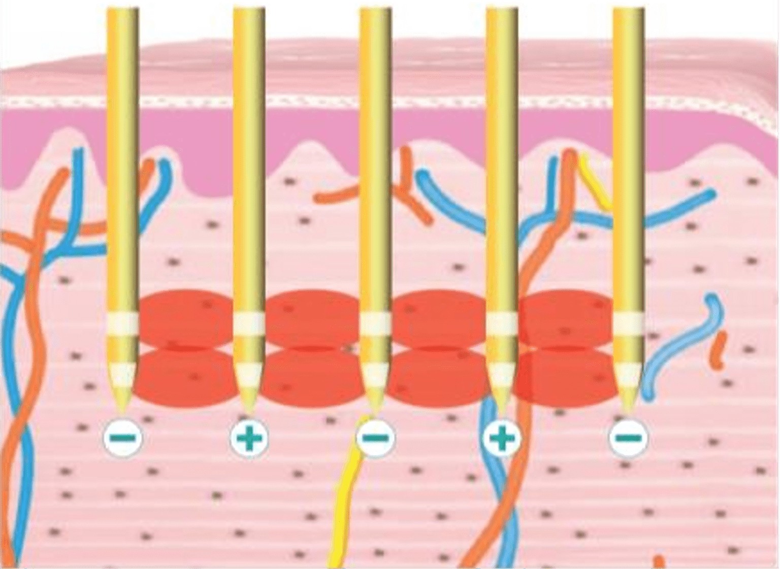 Update นวัตกรรมยกกระชับผิว ดูแลหลุมสิว ลดริ้วรอย: Potenza RF Microneedling โพเทนซ่า