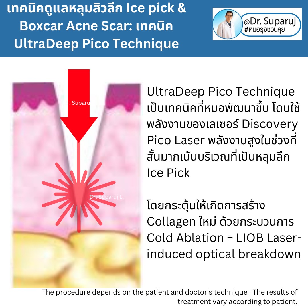 แนะนำเทคนิครักษาหลุมสิวจิกลึก Ice Pick Acne Scar ด้วยเทคนิคเลเซอร์ UltraDeep Pico Technique (Ice Pick Acne Scar Treatment with Discovery Pico Laser + UltraDeep Pico Technique) แนะนำเทคนิครักษาหลุมสิวจิกลึก Ice Pick Acne Scar ด้วยเทคนิคเลเซอร์ UltraDeep Pico Technique (Ice Pick Acne Scar Treatment with Discovery Pico Laser + UltraDeep Pico Technique)