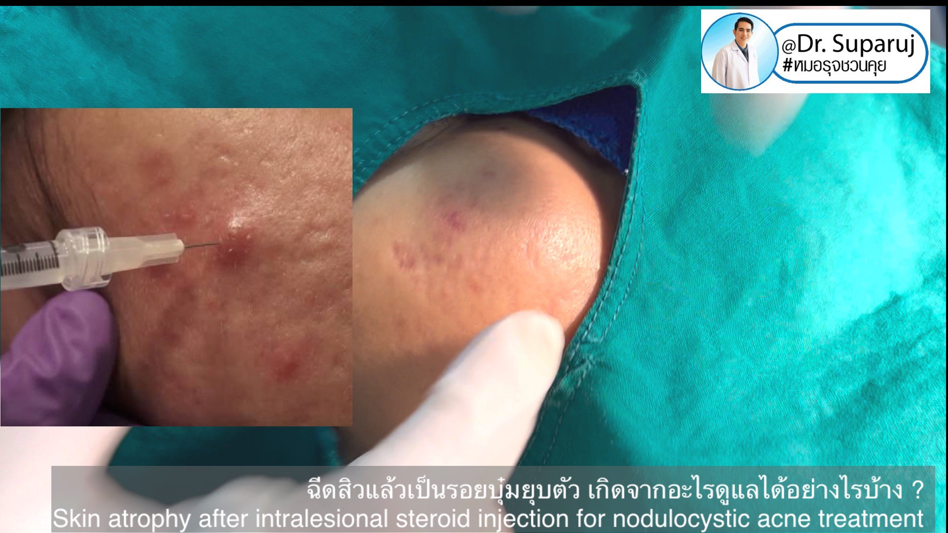 ฉีดสิวแล้วเป็นรอยบุ๋มยุบตัว เกิดจากอะไรดูแลได้อย่างไรบ้าง ? (Skin atrophy after intralesional steroid injection for nodulocystic acne treatment ) ฉีดสิวแล้วเป็นรอยบุ๋มยุบตัว เกิดจากอะไรดูแลได้อย่างไรบ้าง ? (Skin atrophy after intralesional steroid injection for nodulocystic acne treatment )