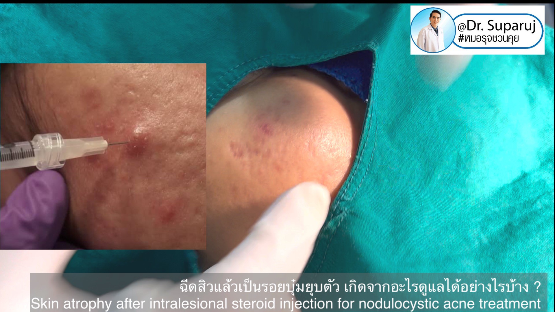 ฉีดสิวแล้วเป็นรอยบุ๋มยุบตัว เกิดจากอะไรดูแลได้อย่างไรบ้าง ?  (Skin atrophy after intralesional steroid injection for nodulocystic acne treatment )