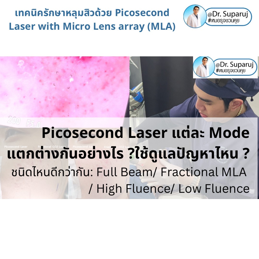 แนะนำเทคนิคดูแลหลุมสิว: Picosecond Laser แต่ละ Mode แตกต่างกันอย่างไร ? ใช้ดูแลปัญหาไหน ชนิดไหนดีกว่ากัน: Full Beam/ Fractional MLA ?/ High Fluence/ Low Fluence