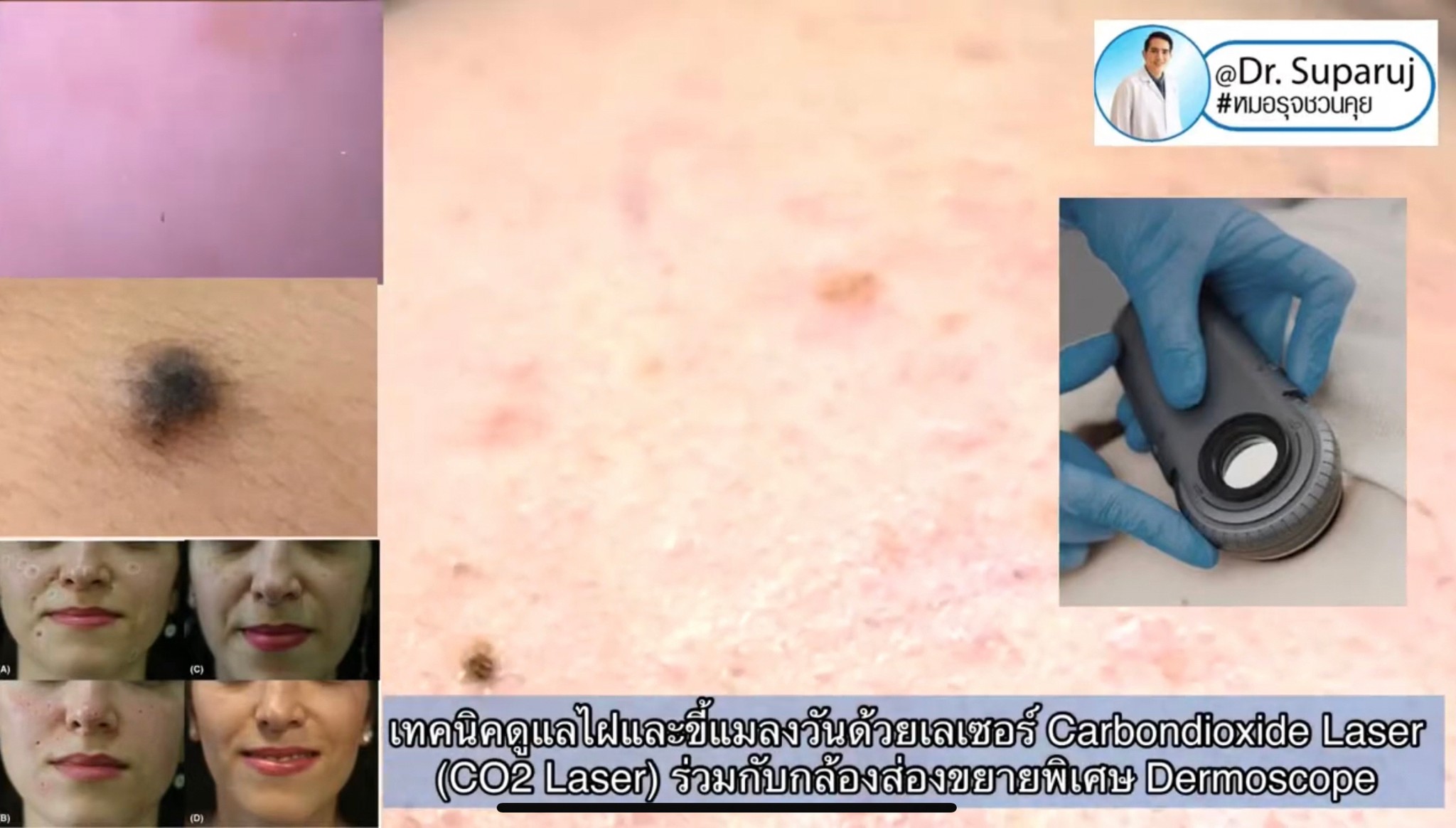 เทคนิคการใช้อุปกรณ์ช่วยวินิจฉัย & ดูแลปัญหาผิวหนัง ฝ้า กระ หลุมสิว: กล้องขยาย Dermoscopy, แว่นขยายพร้อมแสงในช่วงUV: Wood’s Lamp, เครื่องสแกนหาเส้นเลือด Vein Scanner เทคนิคการใช้อุปกรณ์ช่วยวินิจฉัย & ดูแลปัญหาผิวหนัง ฝ้า กระ หลุมสิว: กล้องขยาย Dermoscopy, แว่นขยายพร้อมแสงในช่วงUV: Wood’s Lamp, เครื่องสแกนหาเส้นเลือด Vein Scanner