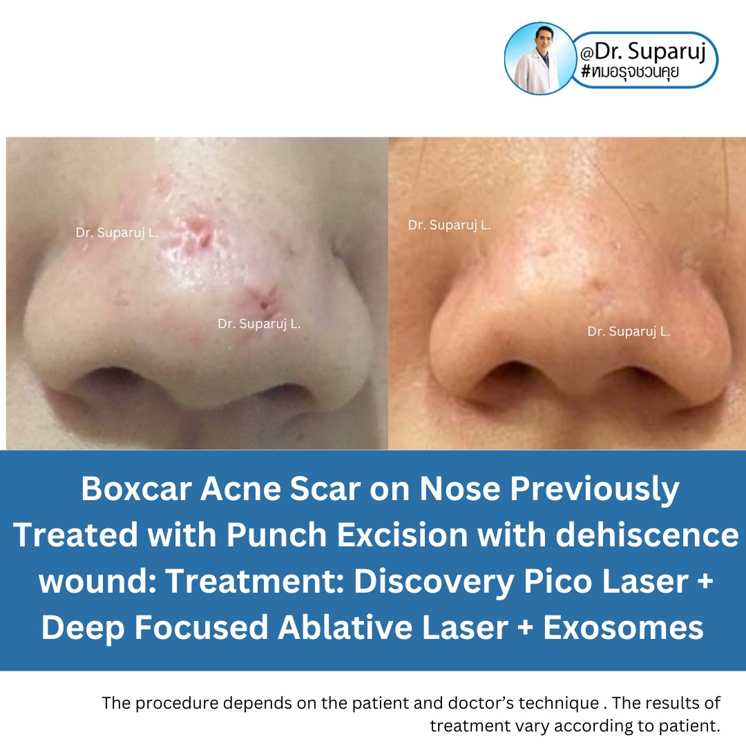 แนะนำเทคนิคดูแลรักษาหลุมสิว: เทคนิครักษาหลุมสิวด้วย 2 เทคนิคเสริมประสิทธิภาพ SYLFIRM X Plus + Discovery Pico Laser Combination Treatment แนะนำเทคนิคดูแลรักษาหลุมสิว: เทคนิครักษาหลุมสิวด้วย 2 เทคนิคเสริมประสิทธิภาพ SYLFIRM X Plus + Discovery Pico Laser Combination Treatment