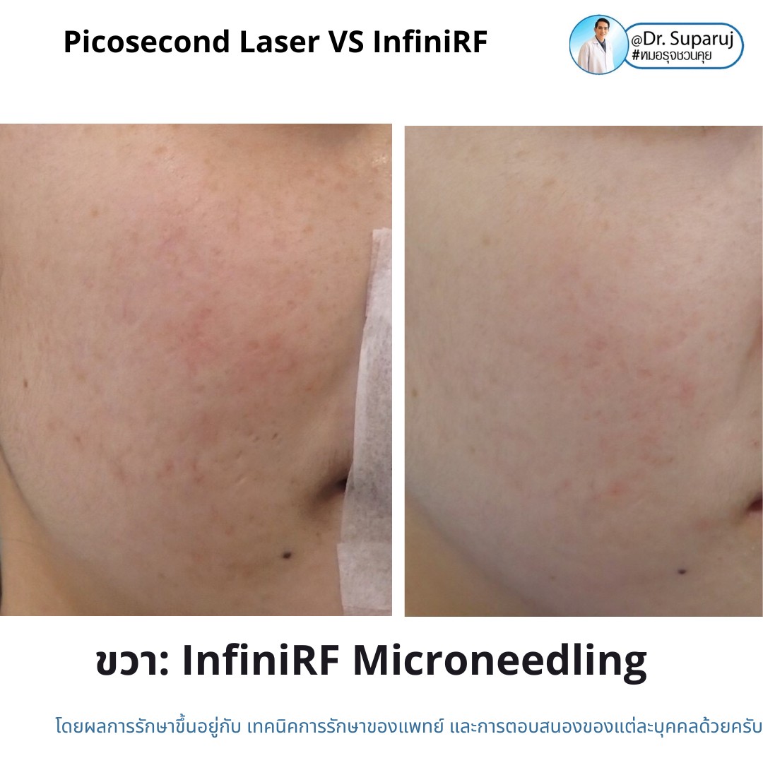 แนะนำเทคนิครักษาหลุมสิว: ดูแลหลุมสิวด้วยเข็มพลังงานคลื่นวิทยุ Infini RF Microneedle แนะนำเทคนิครักษาหลุมสิว: ดูแลหลุมสิวด้วยเข็มพลังงานคลื่นวิทยุ Infini RF Microneedle