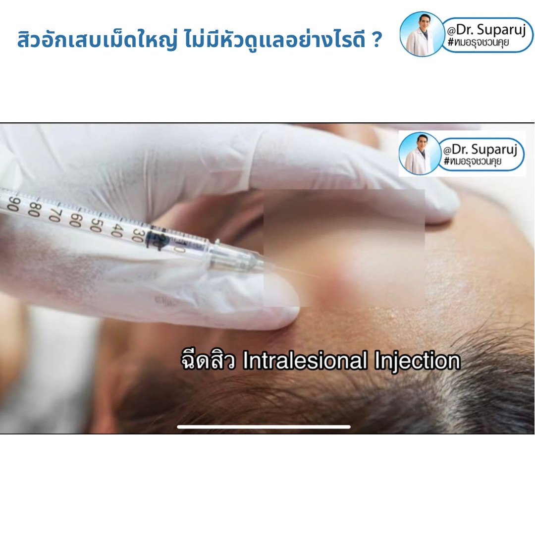 มีสิวอักเสบเม็ดใหญ่ ไม่มีหัว ขึ้น ดูแลอย่างไรดี ? มีสิวอักเสบเม็ดใหญ่ ไม่มีหัว ขึ้น ดูแลอย่างไรดี ?