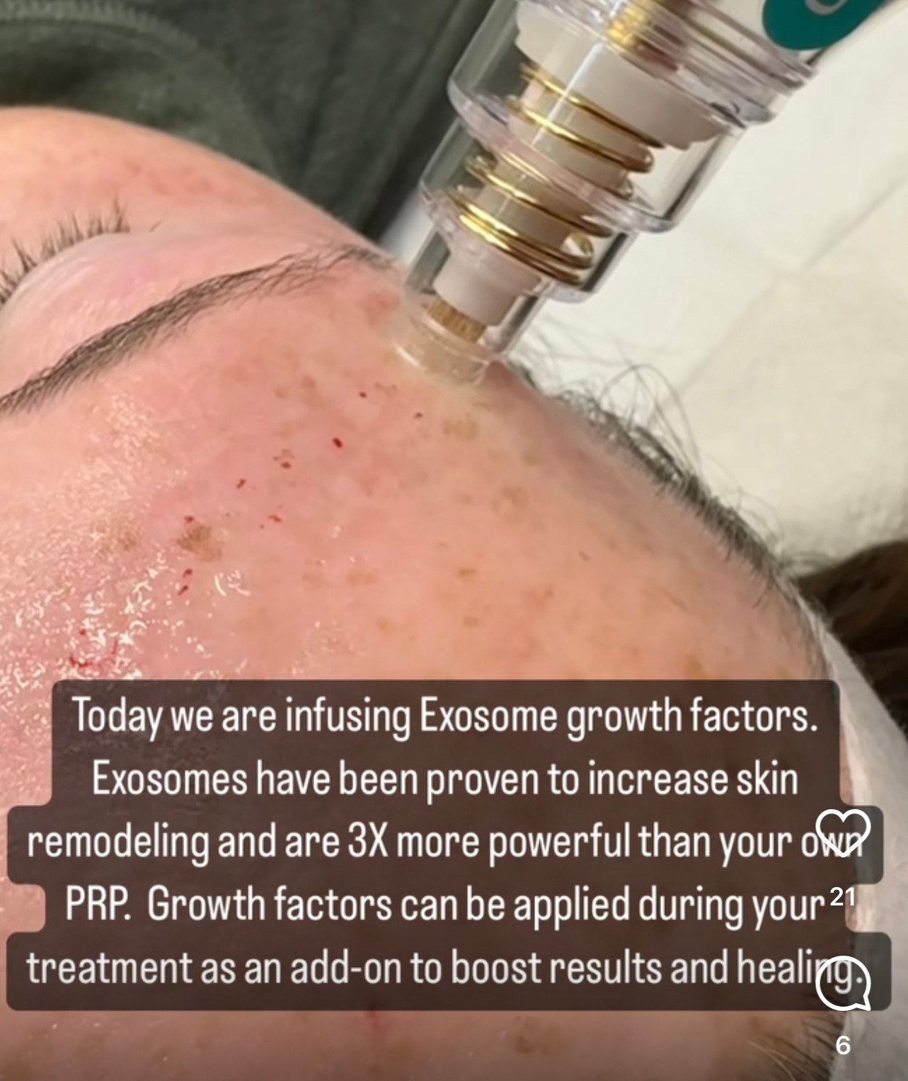 Update นวัตกรรมยกกระชับผิว ดูแลหลุมสิว ลดริ้วรอย: Potenza RF Microneedling โพเทนซ่า Update นวัตกรรมยกกระชับผิว ดูแลหลุมสิว ลดริ้วรอย: Potenza RF Microneedling โพเทนซ่า