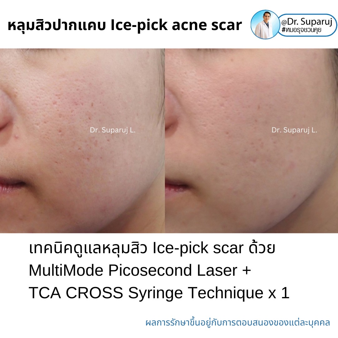 แนะนำเทคนิครักษาหลุมสิวจิกลึก Ice Pick Acne Scar ด้วยเทคนิคเลเซอร์ UltraDeep Pico Technique (Ice Pick Acne Scar Treatment with Discovery Pico Laser + UltraDeep Pico Technique) แนะนำเทคนิครักษาหลุมสิวจิกลึก Ice Pick Acne Scar ด้วยเทคนิคเลเซอร์ UltraDeep Pico Technique (Ice Pick Acne Scar Treatment with Discovery Pico Laser + UltraDeep Pico Technique)