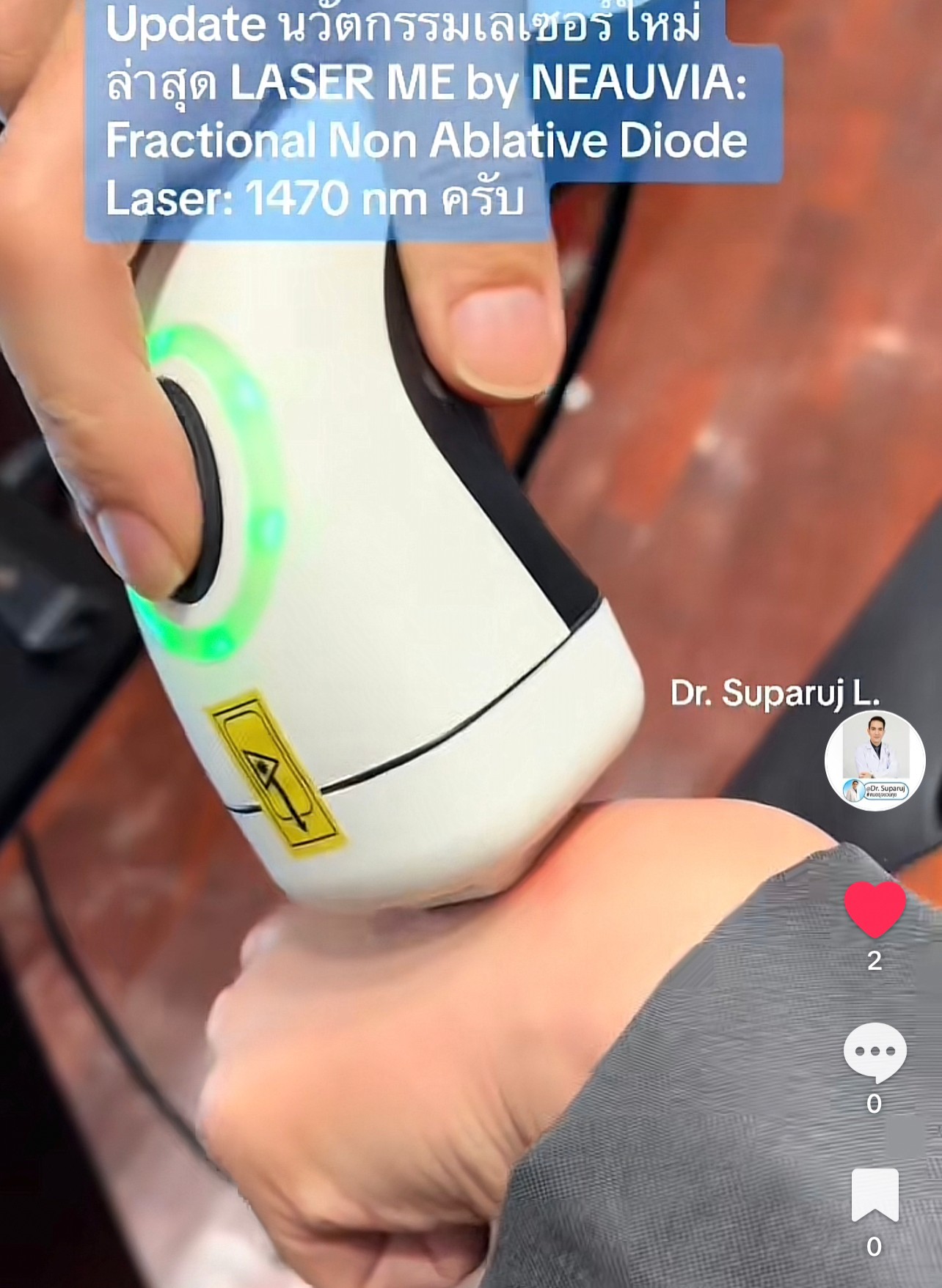 Update นวัตกรรมเลเซอร์ใหม่ล่าสุด LASER ME by NEAUVIA: Fractional Non Ablative Diode Laser: 1470 nm ช่วยดูแลปัญหาหลุมสิว ริ้วรอย แผลเป็น รูขุมขน Update นวัตกรรมเลเซอร์ใหม่ล่าสุด LASER ME by NEAUVIA: Fractional Non Ablative Diode Laser: 1470 nm ช่วยดูแลปัญหาหลุมสิว ริ้วรอย แผลเป็น รูขุมขน