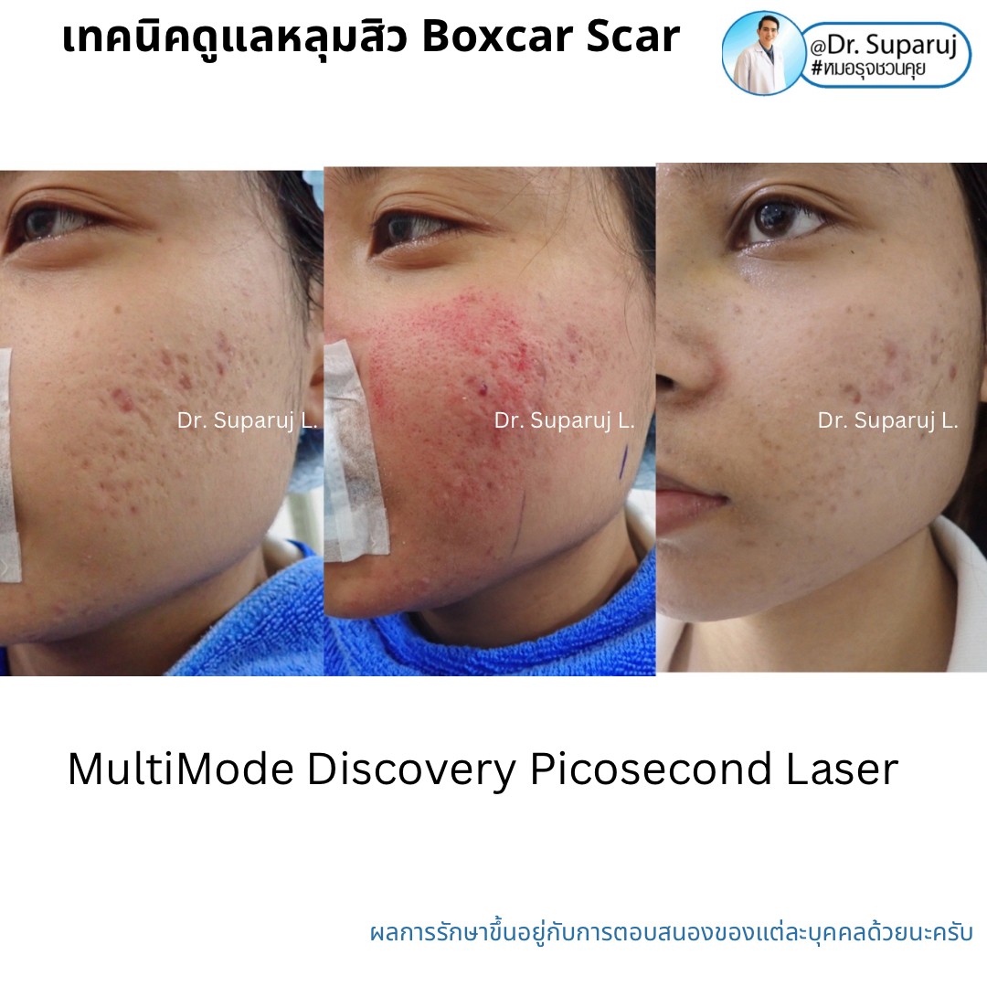 Update รักษาหลุมสิวด้วยเทคนิคการตัดพังผืด Blunt Blade Subcision (Blunt Blade Subcision for Acne Scar Fibrosis Treatment) Update รักษาหลุมสิวด้วยเทคนิคการตัดพังผืด Blunt Blade Subcision (Blunt Blade Subcision for Acne Scar Fibrosis Treatment)