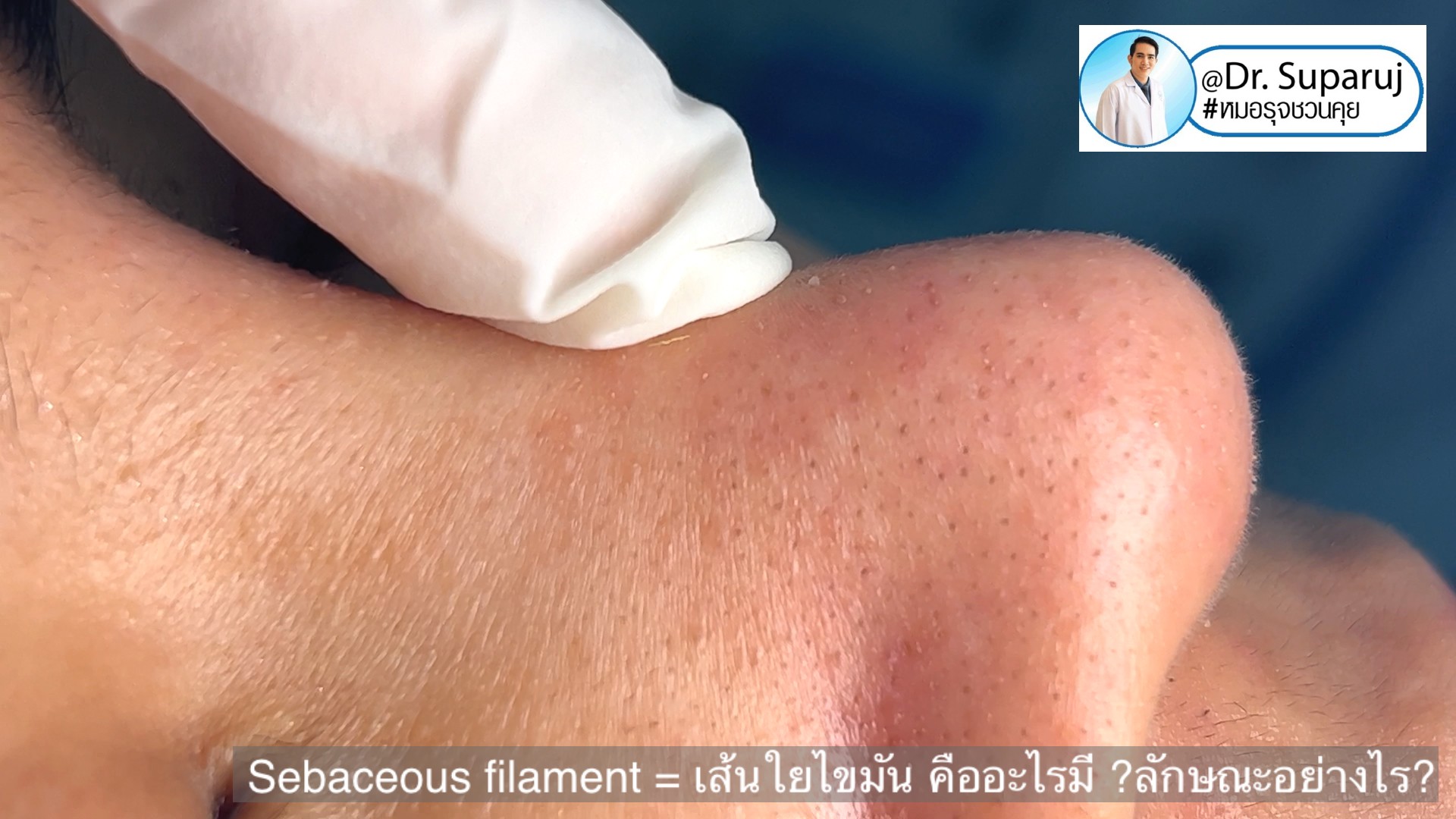 Sebaceous filament = เส้นใยไขมัน คืออะไรมี ?ลักษณะอย่างไร ? ดูแลได้อย่างไร? (คลิปเต็ม Full Clip YouTube Facebook: Dr. Suparuj ครับ