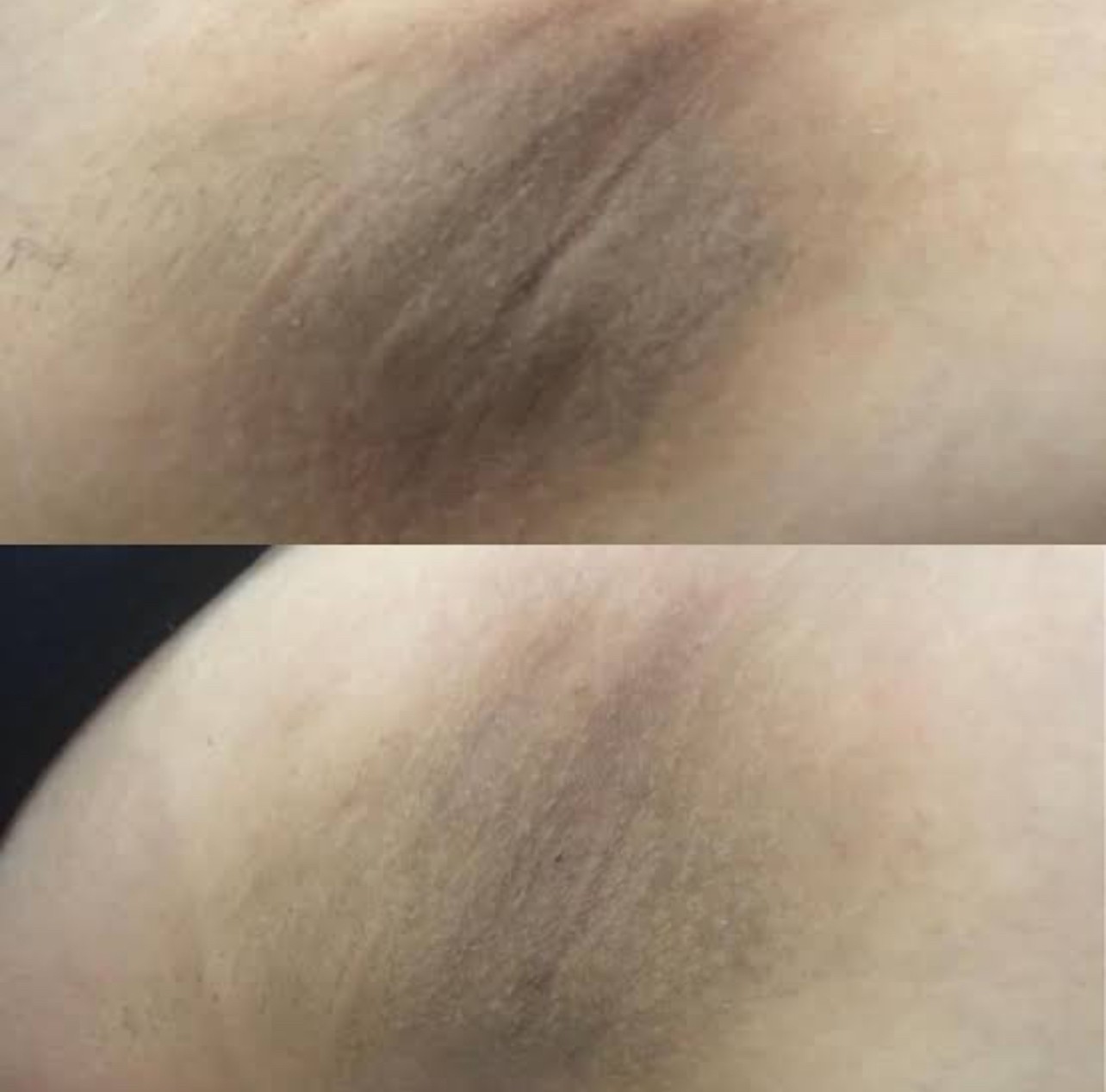 รักแร้ดำเกิดจากสาเหตุอะไร & ดูแลอย่างไร ? รักแร้ดำเกิดจากสาเหตุอะไร & ดูแลอย่างไร ?