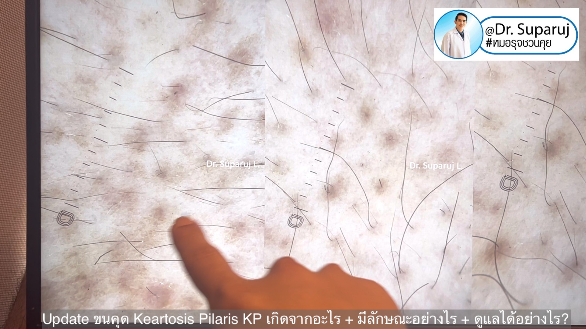 Update ขนคุด Keartosis Pilaris KP เกิดจากอะไร + มีลักษณะอย่างไร + ดูแลได้อย่างไร? Update ขนคุด Keartosis Pilaris KP เกิดจากอะไร + มีลักษณะอย่างไร + ดูแลได้อย่างไร?