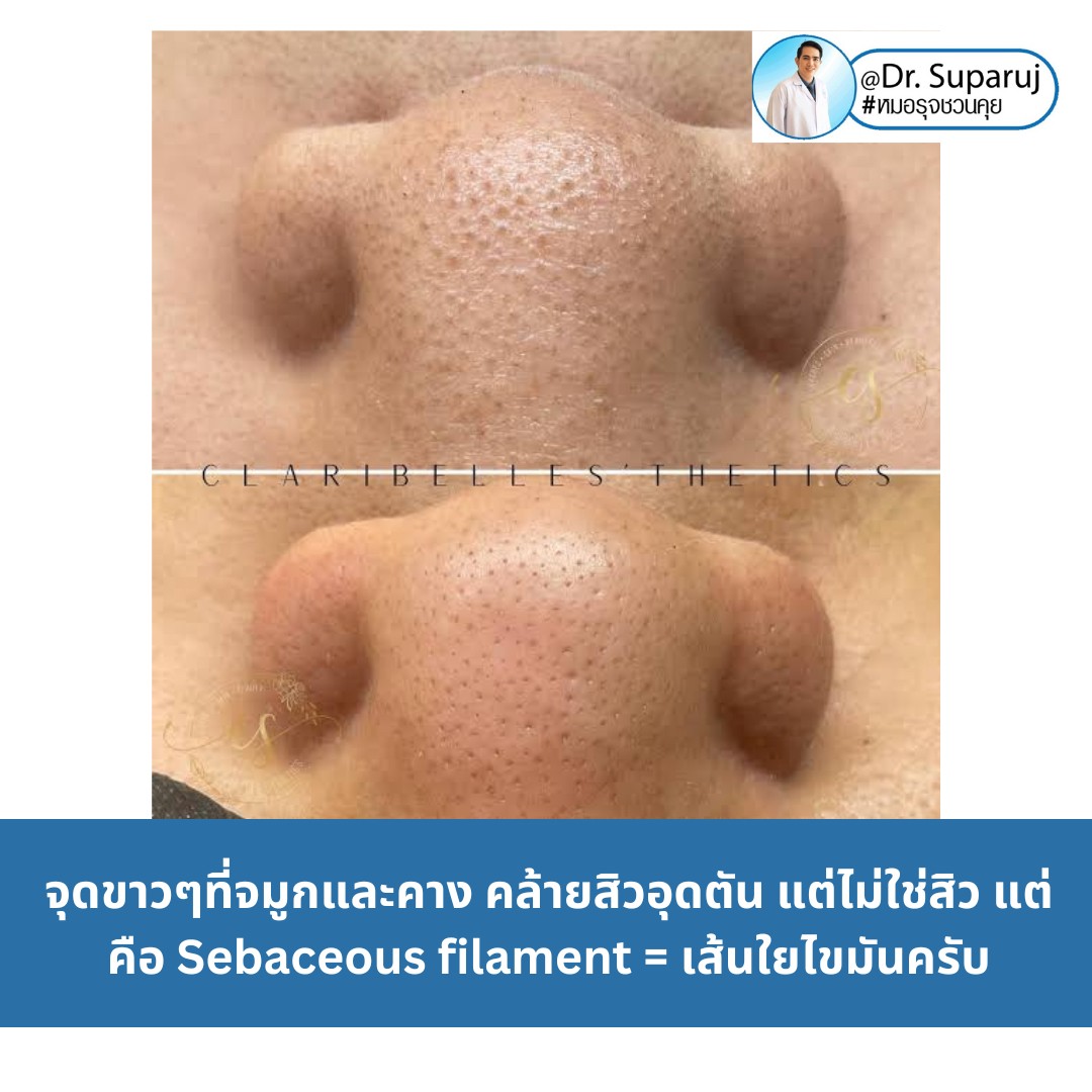 Sebaceous filament = เส้นใยไขมัน คืออะไรมี ?ลักษณะอย่างไร ? ดูแลได้อย่างไร? (คลิปเต็ม Full Clip YouTube Facebook: Dr. Suparuj ครับ