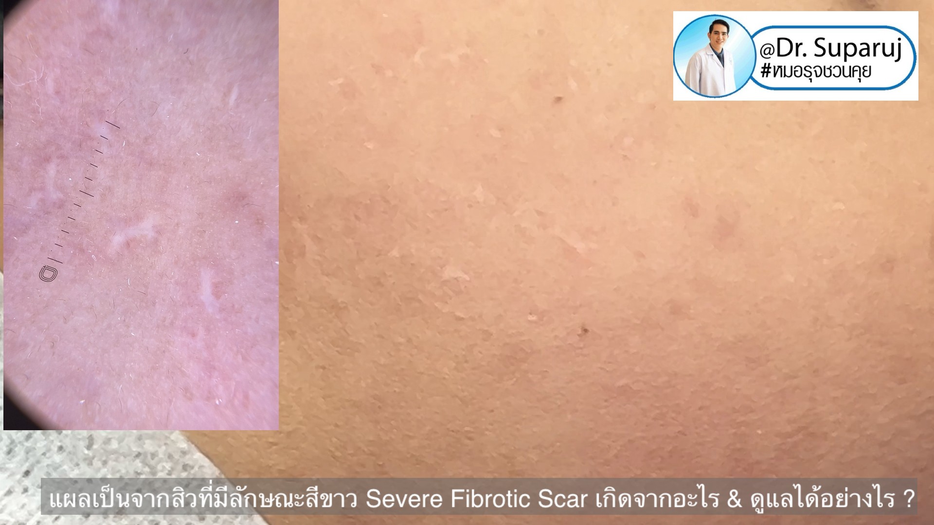 แผลเป็นจากสิวที่มีลักษณะสีขาว severe fibrotic acne scar เกิดจากอะไร & ดูแลได้อย่างไร ?