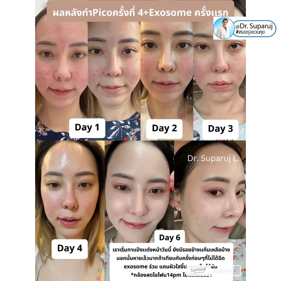 รีวิวรักษาหลุมสิวด้วย Pico Laser +Exosome มันเริดมากแม๊