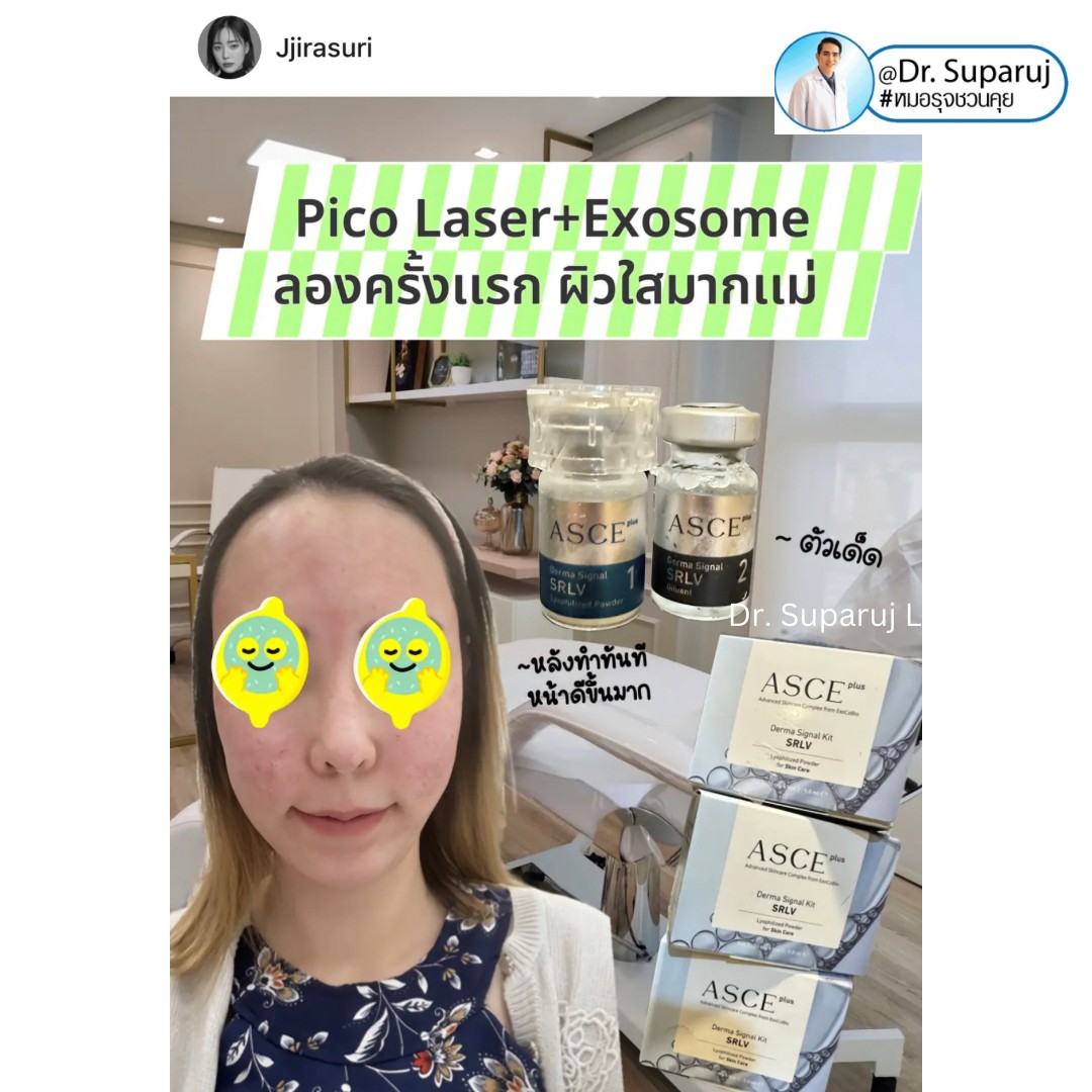 รีวิวรักษาหลุมสิวด้วย Pico Laser +Exosome มันเริดมากแม๊ รีวิวรักษาหลุมสิวด้วย Pico Laser +Exosome มันเริดมากแม๊