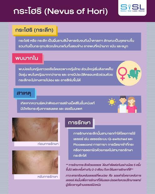 เทคนิคดูแลปานแต่กำเนิดด้วยเลเซอร์ดิสคัฟเวอรี่พิโค Birthmark Treatment with Special Handpieces of Discovery Pico Laser เทคนิคดูแลปานแต่กำเนิดด้วยเลเซอร์ดิสคัฟเวอรี่พิโค Birthmark Treatment with Special Handpieces of Discovery Pico Laser