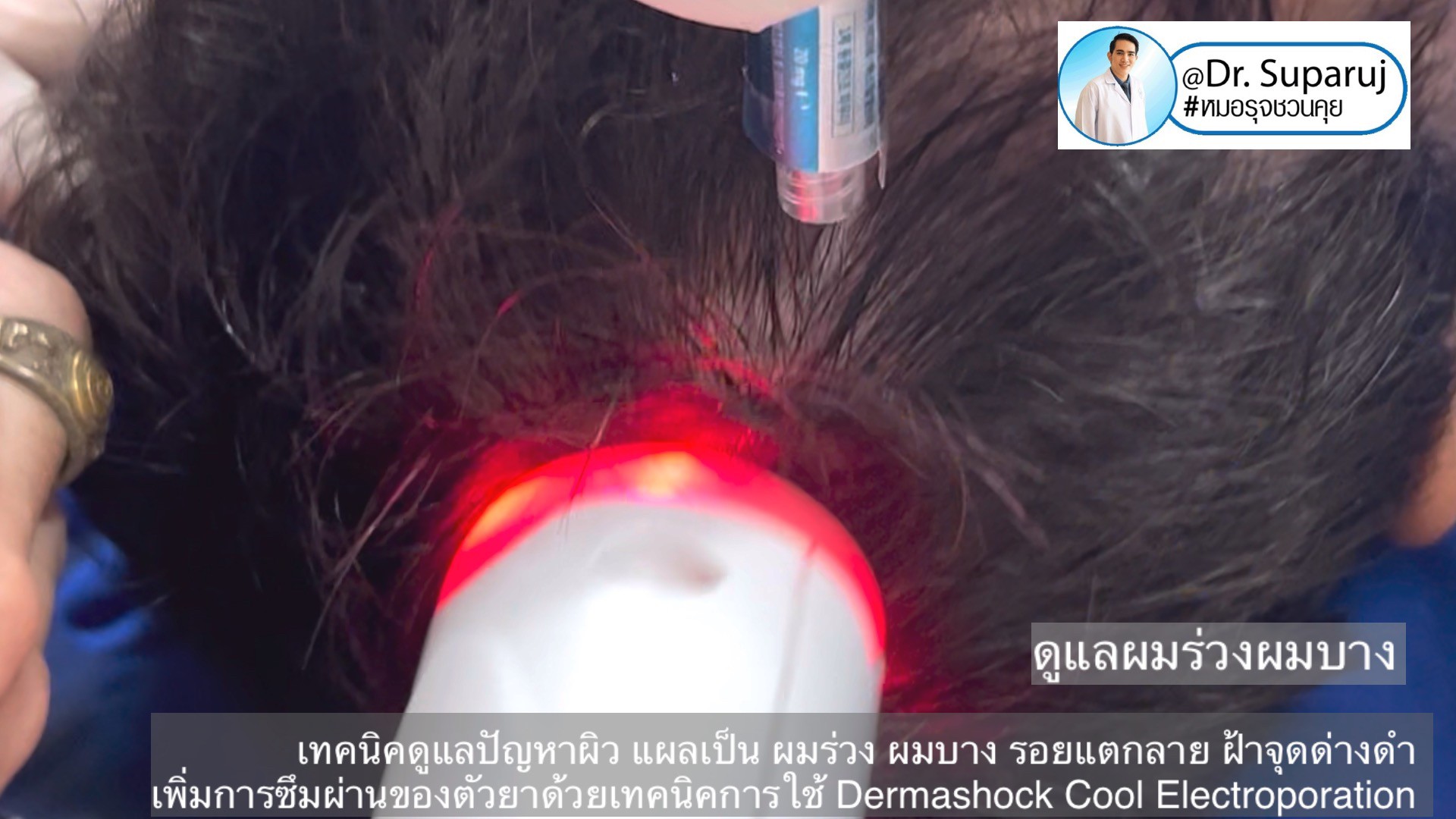 เทคนิคดูแลปัญหาผิว แผลเป็น ผมร่วง ผมบาง รอยแตกลาย ฝ้าจุดด่างดำ เพิ่มการซึมผ่านของตัวยาด้วยเทคนิคการใช้ Dermashock Cool Electroporation เทคนิคดูแลปัญหาผิว แผลเป็น ผมร่วง ผมบาง รอยแตกลาย ฝ้าจุดด่างดำ เพิ่มการซึมผ่านของตัวยาด้วยเทคนิคการใช้ Dermashock Cool Electroporation