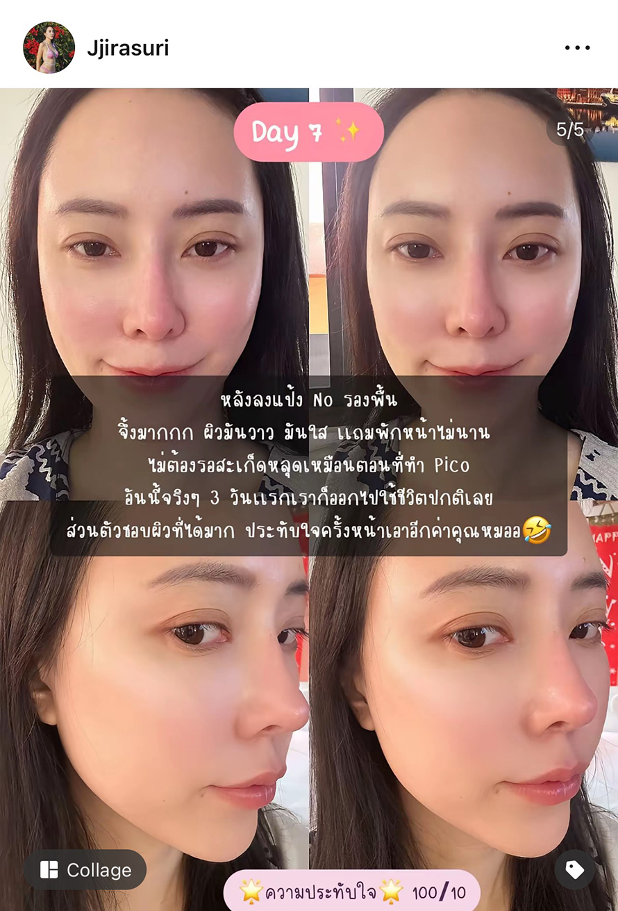 นอกใจโปรแกรมเลเซอร์ Pico ลองของใหม่ โปรแกรม SylfirmXplus ขอบคุณรีวิวดูแลหลุมสิวด้วยโปรแกรม SylfirmX Plus จากคุณจูนครับ นอกใจโปรแกรมเลเซอร์ Pico ลองของใหม่ โปรแกรม SylfirmXplus ขอบคุณรีวิวดูแลหลุมสิวด้วยโปรแกรม SylfirmX Plus จากคุณจูนครับ