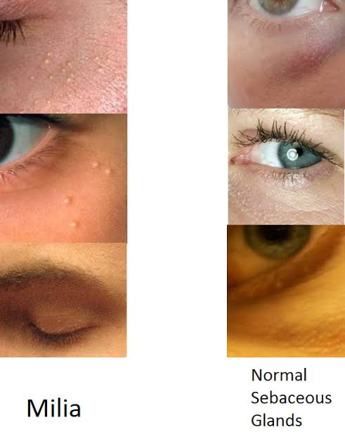 มีตุ่มเล็กๆสีขาวเหลืองหลายๆตุ่มที่เปลือกตาล่างคืออะไร : เป็นต่อมไขมันที่เด่นชัดครับ Prominent sebaceous gland ครับ มีตุ่มเล็กๆสีขาวเหลืองหลายๆตุ่มที่เปลือกตาล่างคืออะไร : เป็นต่อมไขมันที่เด่นชัดครับ Prominent sebaceous gland ครับ