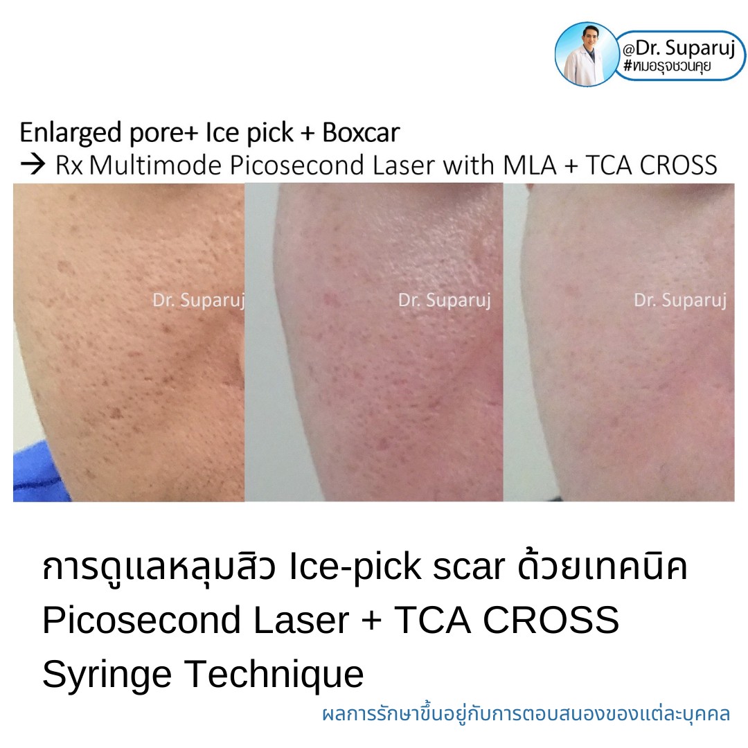  แนะนำเทคนิครักษาหลุมสิวจิกลึก Ice Pick Acne Scar ด้วยเทคนิคเลเซอร์ UltraDeep Pico Technique (Ice Pick Acne Scar Treatment with Discovery Pico Laser + UltraDeep Pico Technique)