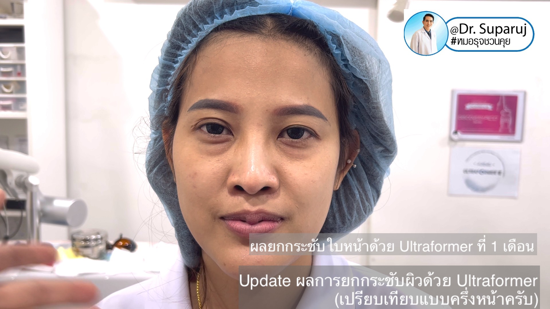 Update ผลการยกกระชับผิวด้วย Ultraformer III (เปรียบเทียบแบบครึ่งหน้าให้เห็นชัดๆครับ) Update ผลการยกกระชับผิวด้วย Ultraformer III (เปรียบเทียบแบบครึ่งหน้าให้เห็นชัดๆครับ)