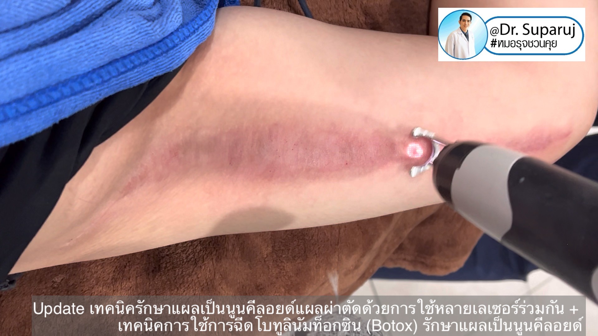 Update เทคนิครักษาแผลเป็นนูนคีลอยด์แผลผ่าตัดด้วยการใช้หลายเลเซอร์ร่วมกัน + เทคนิคการใช้การฉีดโบทูลินัมท็อกซิน (Botox) รักษาแผลเป็นนูนคีลอยด์ Update เทคนิครักษาแผลเป็นนูนคีลอยด์แผลผ่าตัดด้วยการใช้หลายเลเซอร์ร่วมกัน + เทคนิคการใช้การฉีดโบทูลินัมท็อกซิน (Botox) รักษาแผลเป็นนูนคีลอยด์