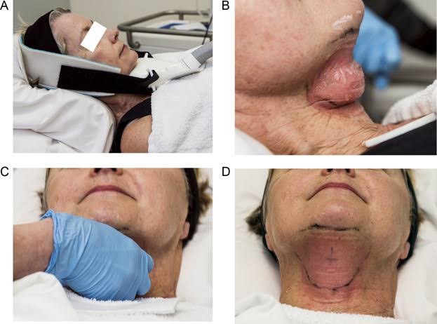 สาเหตุ & เทคนิคลดเหนียง ไขมันใต้คาง คาง 2 ชั้น Double Chin & Submental Fullness Treatment สาเหตุ & เทคนิคลดเหนียง ไขมันใต้คาง คาง 2 ชั้น Double Chin & Submental Fullness Treatment