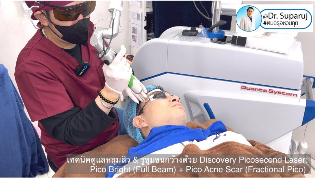 Update Discovery Picosecond Laser จุดเด่น & หลักการทำงาน ใช้ดูแลหลุมสิว แผลเป็น รอยแตกลาย ฝ้า กระจุดด่างดำ ได้อย่างไร ? Update Discovery Picosecond Laser จุดเด่น & หลักการทำงาน ใช้ดูแลหลุมสิว แผลเป็น รอยแตกลาย ฝ้า กระจุดด่างดำ ได้อย่างไร ?
