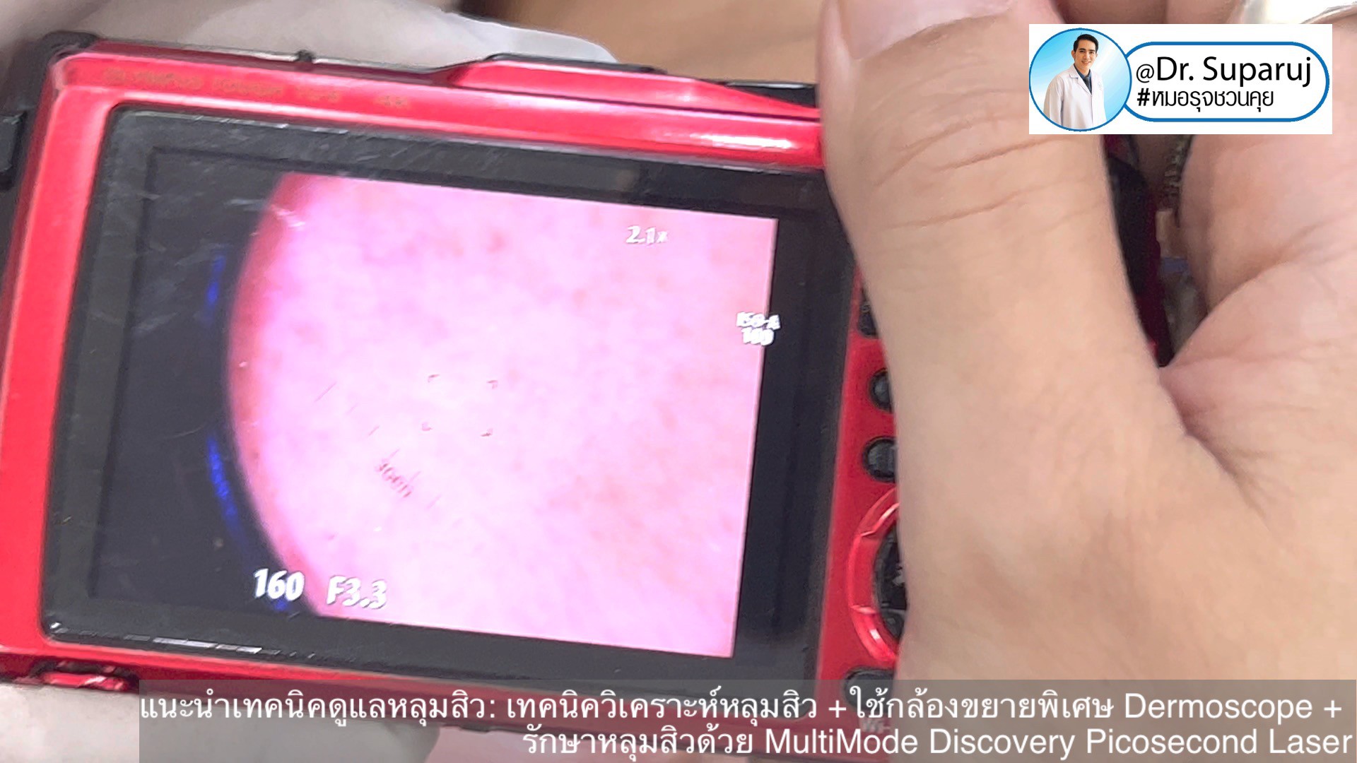 แนะนำเทคนิคดูแลหลุมสิว: เทคนิควิเคราะห์หลุมสิว +ใช้กล้องขยายพิเศษ Dermoscope + รักษาหลุมสิวด้วย MultiMode Discovery Picosecond Laser + Exosome Therapy แนะนำเทคนิคดูแลหลุมสิว: เทคนิควิเคราะห์หลุมสิว +ใช้กล้องขยายพิเศษ Dermoscope + รักษาหลุมสิวด้วย MultiMode Discovery Picosecond Laser + Exosome Therapy