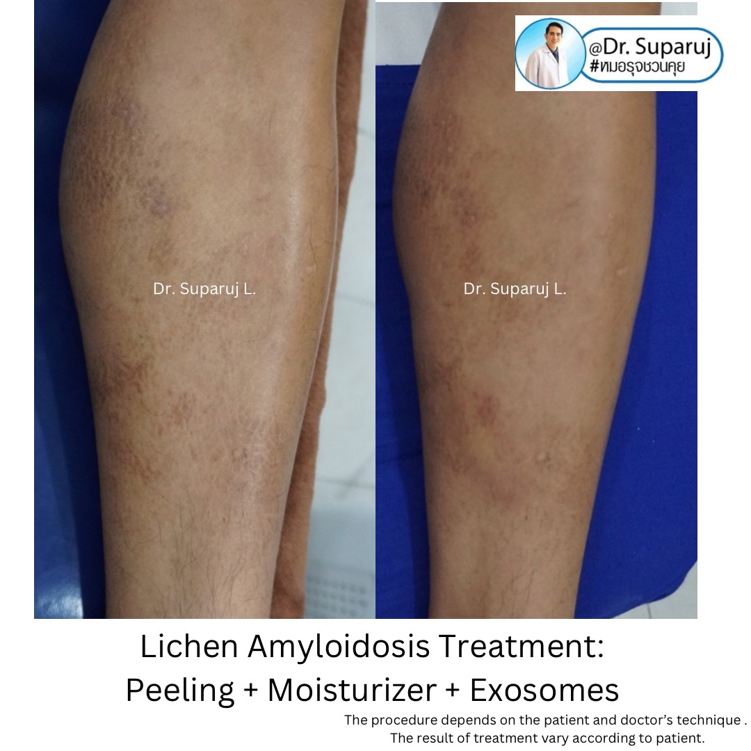 แนะนำการดูแลปัญหาโรคผิวหนัง: โรค Lichen amyloidosis ไลเค่น อะไมลอยโดซิส มีลักษณะอย่างไร ดูแลได้อย่างไร ? แนะนำการดูแลปัญหาโรคผิวหนัง: โรค Lichen amyloidosis ไลเค่น อะไมลอยโดซิส มีลักษณะอย่างไร ดูแลได้อย่างไร ?