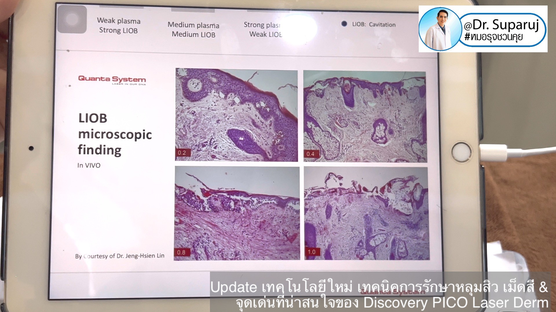 Update เทคโนโลยีใหม่ เทคนิคการรักษาหลุมสิว เม็ดสี & จุดเด่นที่น่าสนใจของ Discovery PICO Laser Derm Update เทคโนโลยีใหม่ เทคนิคการรักษาหลุมสิว เม็ดสี & จุดเด่นที่น่าสนใจของ Discovery PICO Laser Derm