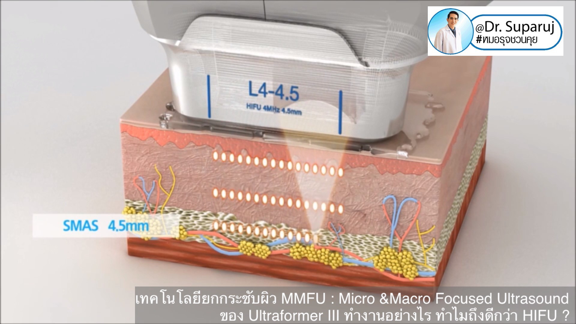 เทคโนโลยียกกระชับผิว MMFU : Micro &Macro Focused Ultrasound ของ Ultraformer III ทำงานอย่างไร ทำไมถึงดีกว่า HIFU ? เทคโนโลยียกกระชับผิว MMFU : Micro &Macro Focused Ultrasound ของ Ultraformer III ทำงานอย่างไร ทำไมถึงดีกว่า HIFU ?