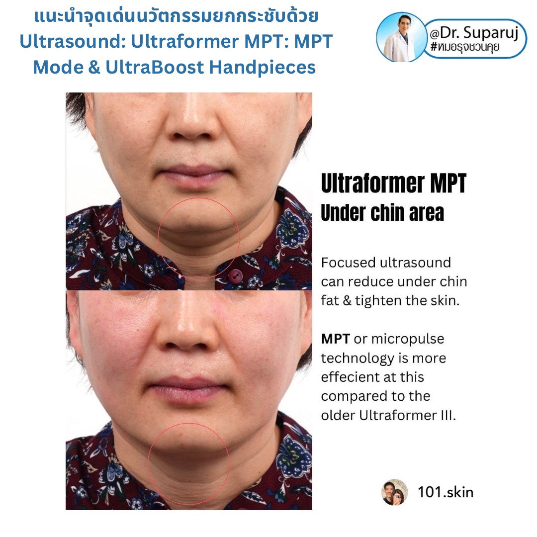แนะนำนวัตกรรม พลังงานเครื่องเสียง Macro & Micro Focused Ultrasound ยกกระชับผิว Ultraformer MPT: จุดเด่น + ทดสอบลักษณะพลังงาน + การประเมินลักษณะผิว ให้เห็นกันชัดๆเลยครับ แนะนำนวัตกรรม พลังงานเครื่องเสียง Macro & Micro Focused Ultrasound ยกกระชับผิว Ultraformer MPT: จุดเด่น + ทดสอบลักษณะพลังงาน + การประเมินลักษณะผิว ให้เห็นกันชัดๆเลยครับ