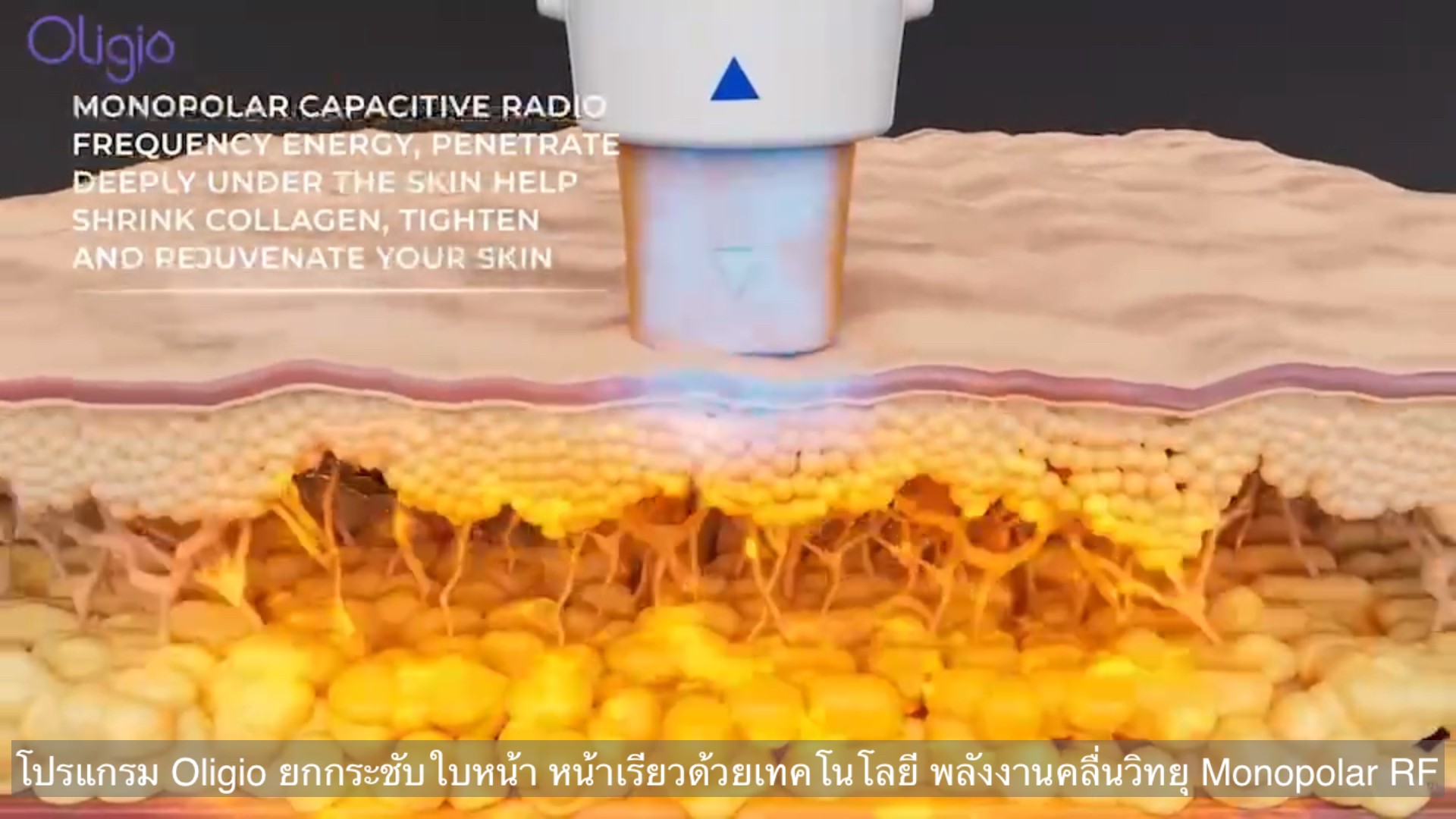 ยกกระชับผิวหน้าด้วย โปรแกรม Oligio Monopolar RF มีกลไก& จุดเด่น อย่างไร ? ยกกระชับผิวหน้าด้วย โปรแกรม Oligio Monopolar RF มีกลไก& จุดเด่น อย่างไร ?