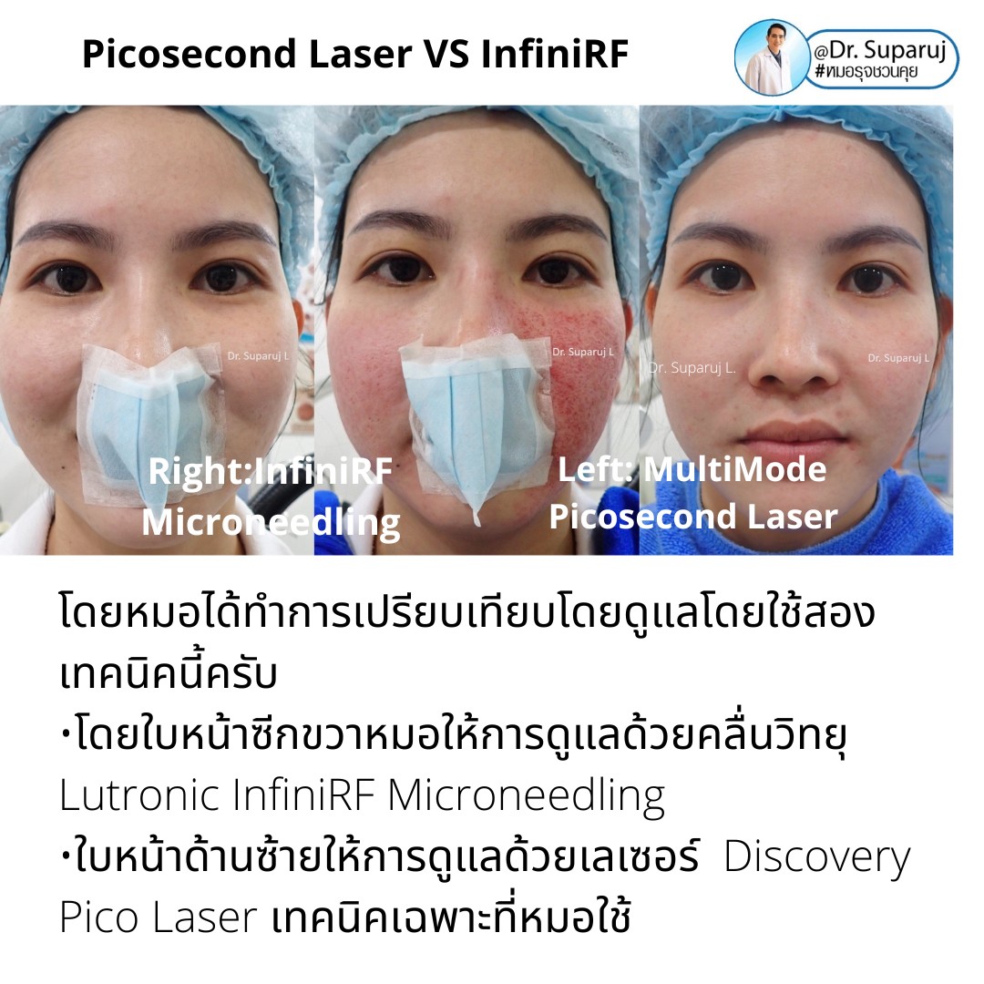 แนะนำเทคนิครักษาหลุมสิว: ดูแลหลุมสิวด้วยเข็มพลังงานคลื่นวิทยุ Infini RF Microneedle