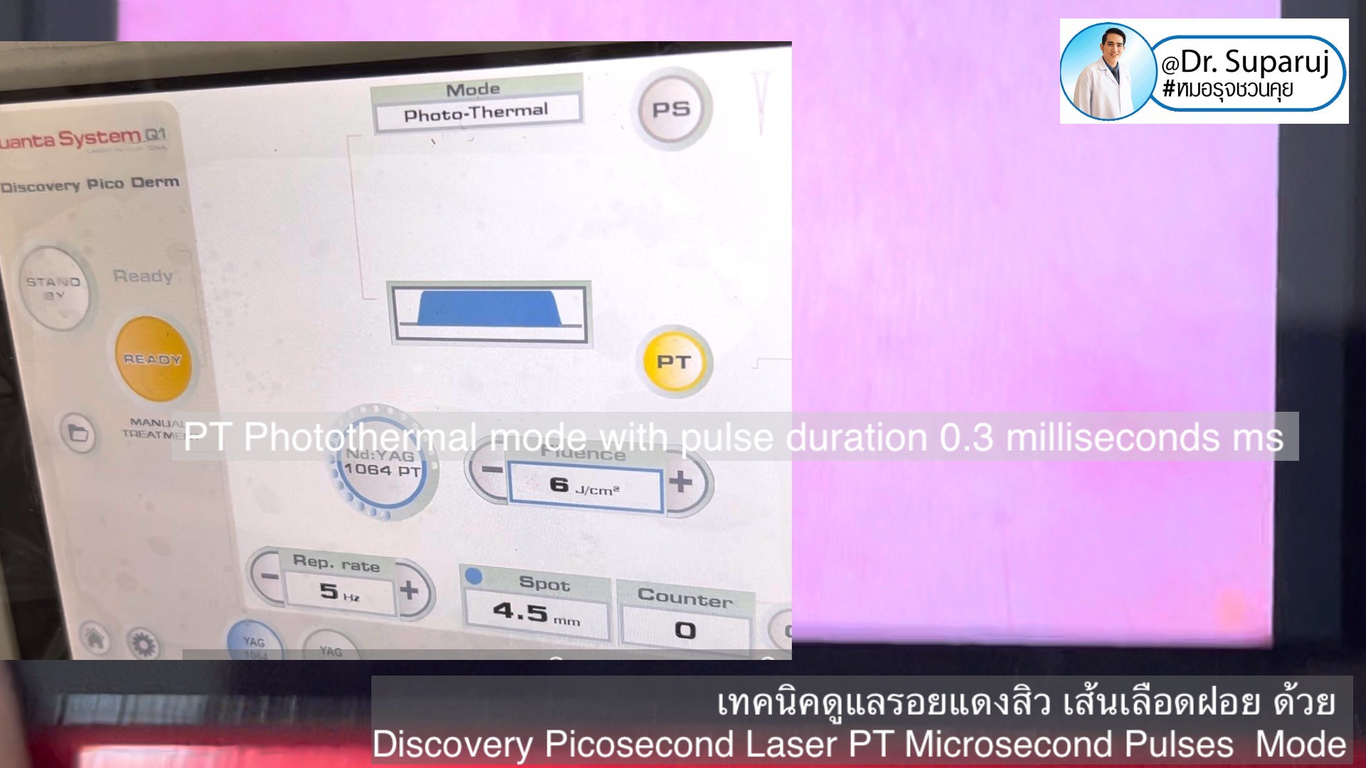 แนะนำเทคนิคดูแลรอยแดงสิว เส้นเลือดฝอย : เทคนิครักษารอยแดงสิว เส้นเลือดฝอย ด้วย Discovery Picosecond Laser PT Microsecond Pulses Mode แนะนำเทคนิคดูแลรอยแดงสิว เส้นเลือดฝอย : เทคนิครักษารอยแดงสิว เส้นเลือดฝอย ด้วย Discovery Picosecond Laser PT Microsecond Pulses Mode