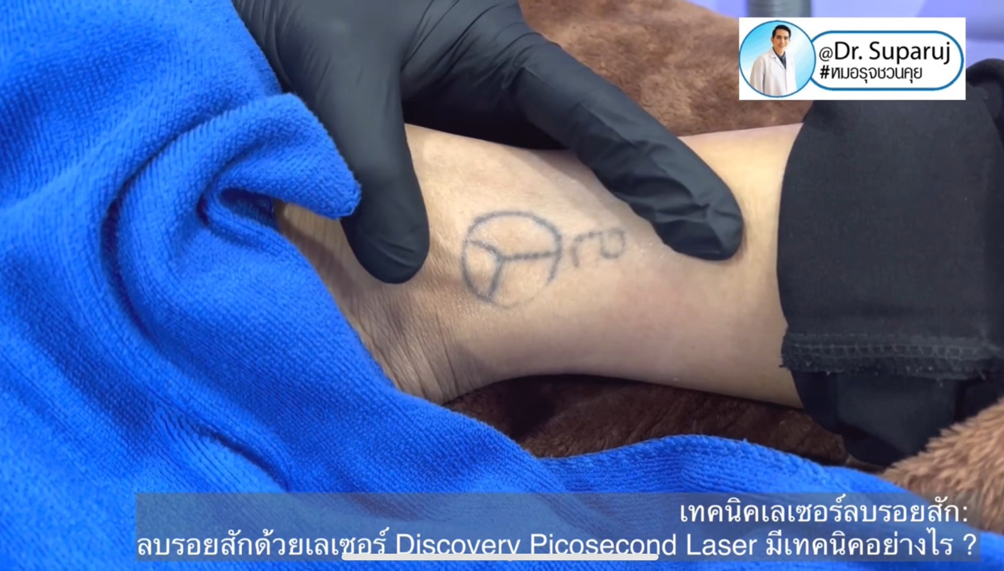 ทำไมต้องลบรอยสักด้วย พิโค่เลเซอร์ Picosecond Laser ทำไมต้องลบรอยสักด้วย พิโค่เลเซอร์ Picosecond Laser