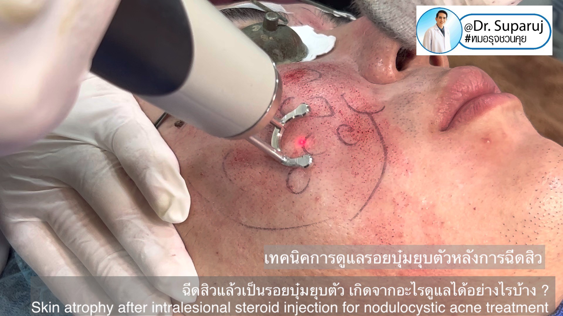 ฉีดสิวแล้วเป็นรอยบุ๋มยุบตัว เกิดจากอะไรดูแลได้อย่างไรบ้าง ? (Skin atrophy after intralesional steroid injection for nodulocystic acne treatment ) ฉีดสิวแล้วเป็นรอยบุ๋มยุบตัว เกิดจากอะไรดูแลได้อย่างไรบ้าง ? (Skin atrophy after intralesional steroid injection for nodulocystic acne treatment )